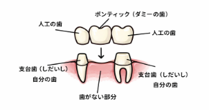 ブリッジ治療