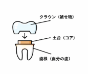 差し歯の構造