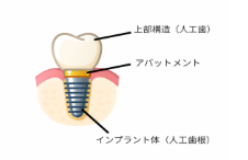 インプラントの構造